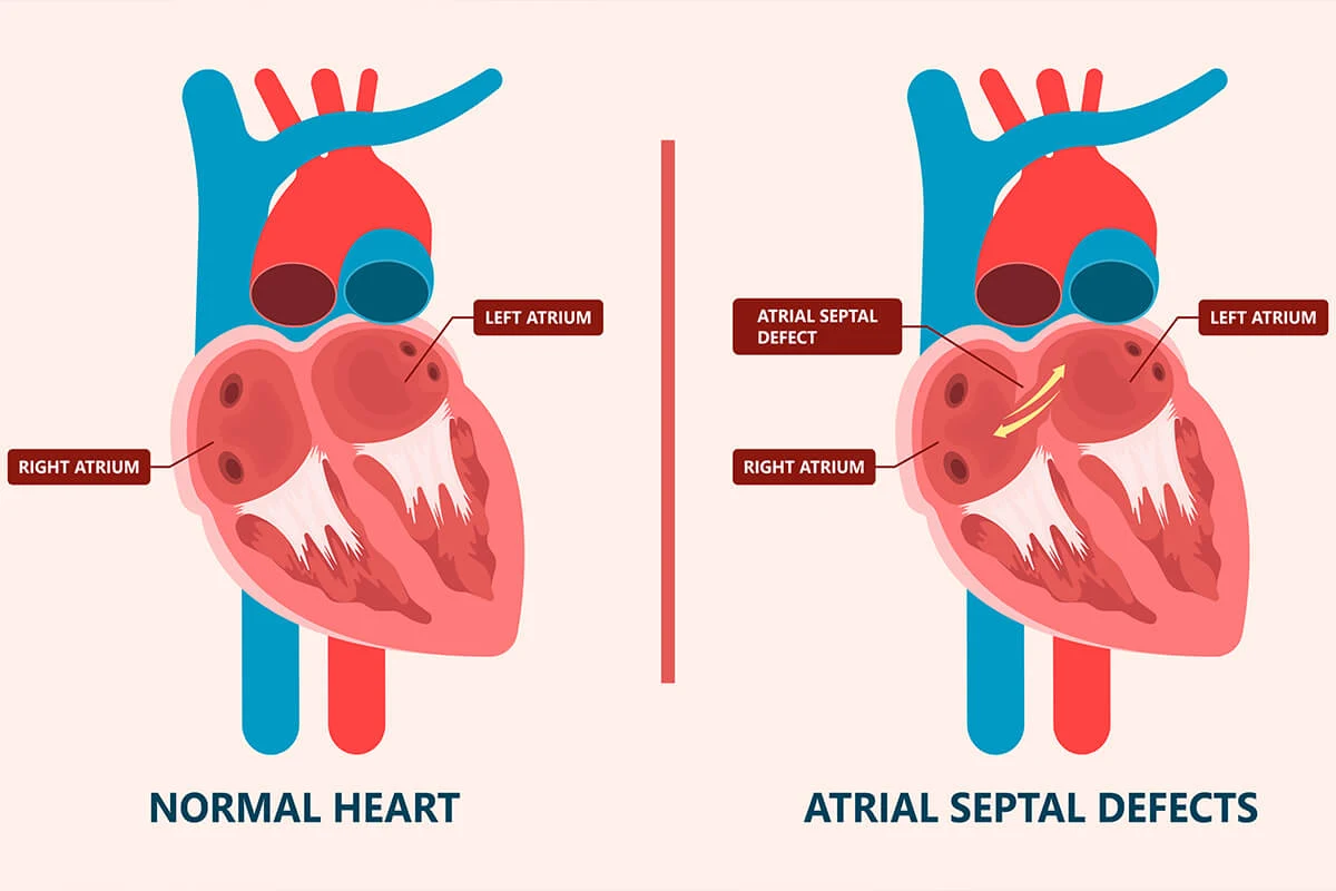 ASD (atriyal septal defekt) Nedir?