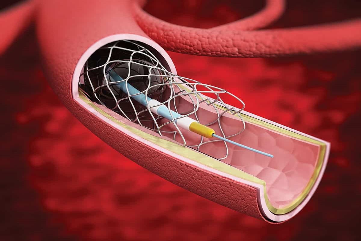 Balon Anjiyoplasti ve Stent