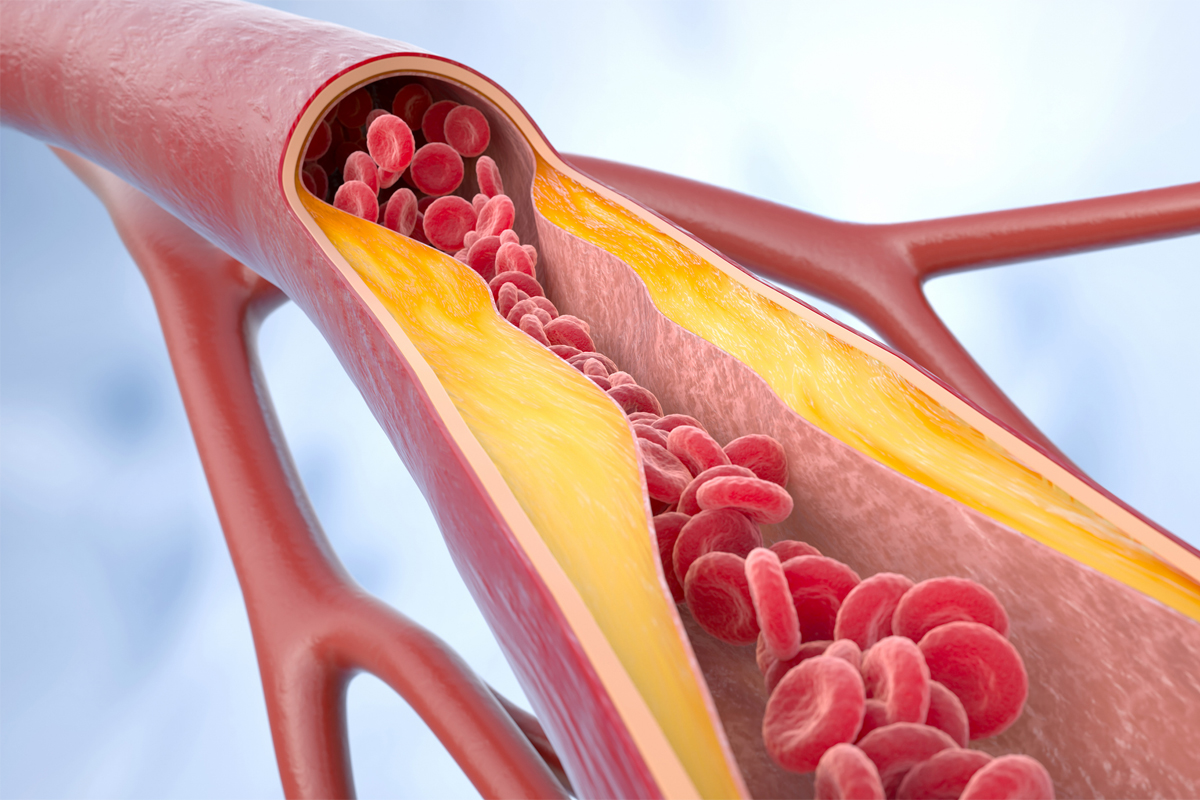 20250115-atherosklerose-iLexx-iStock-GettyImages-1830635687
